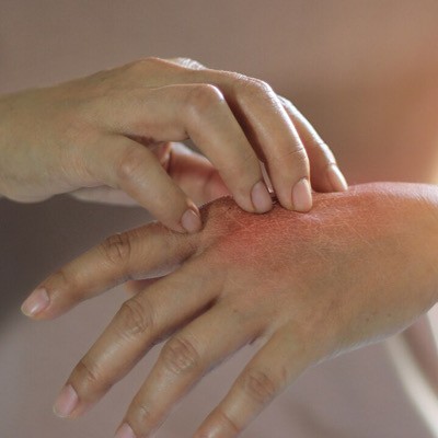 قارچ پوستی و بهترین روش‌های درمان آن