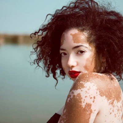 بررسی علائم و درمان بیماری پیسی