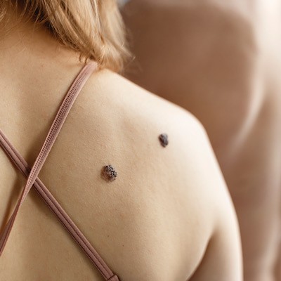 بهترین راهکار‌ها برداشتن خال‌های پوست