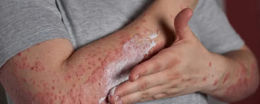 قارچ پوستی و بهترین روشهای درمان آن