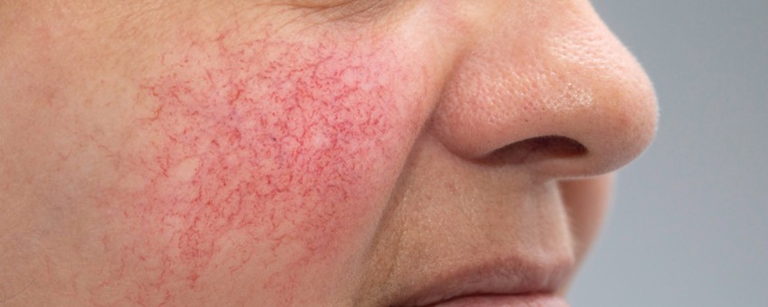 بهترین راهکارهای درمان عروق عنکبوتی